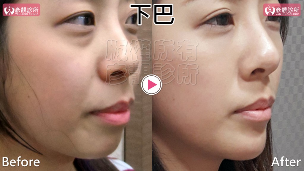 墊下巴 玻尿酸墊下巴vs 手術墊下巴費用 術後後遺症 失敗比較 彥靚診所 醫學美容部門
