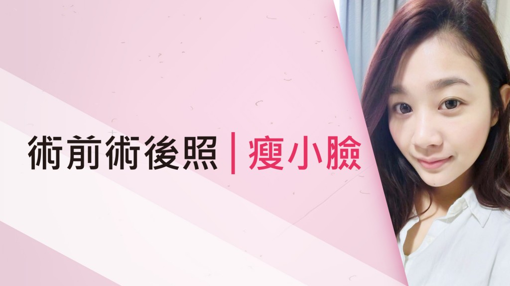 肉毒桿菌瘦小臉