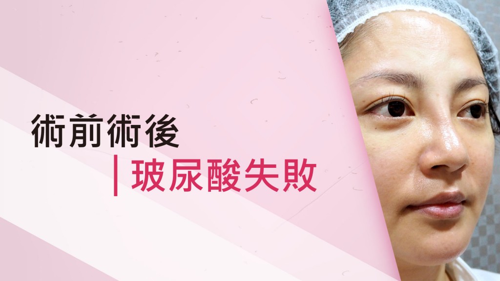 拯救玻尿酸失敗