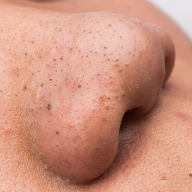 黑頭粉刺擠不完怎麼辦 Dcard Ptt留言推爆 溫和清粉刺 4絕招 堅持一個月九成粉刺都消失 新聞分享 彥靚診所 醫學美容部門